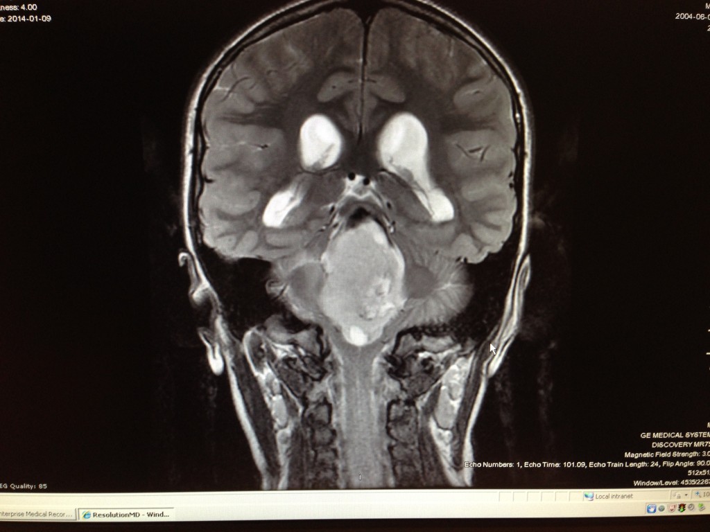 Brain tumor. The light grey oval mass right in the middle of her head.