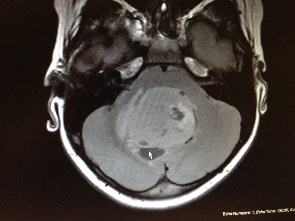 Light grey circle in the middle of her brain. About 2" wide.