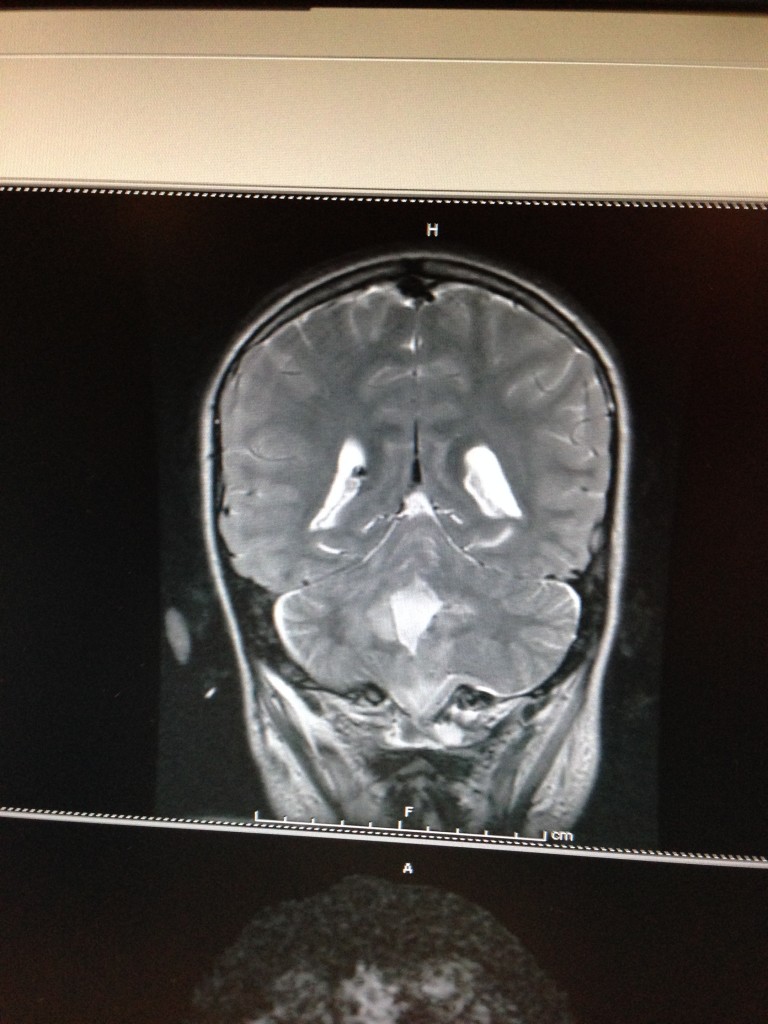 Scan of ventricles a few days after surgery.